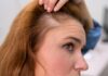Entre 25% y 38% por ciento de las mujeres podría vivir con alopecia de patrón femenino, aunque rara vez llega a la calvicie total
