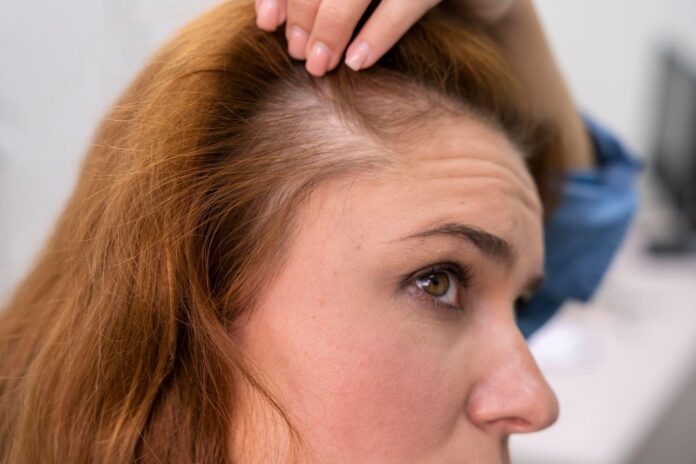 Alopecia 27-10-26.JPEG